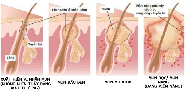 qua trinh tri mun o da