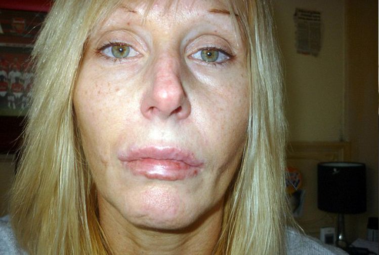Woman, 41, left Disfigured and Covered in Weeping Sores after Permanent